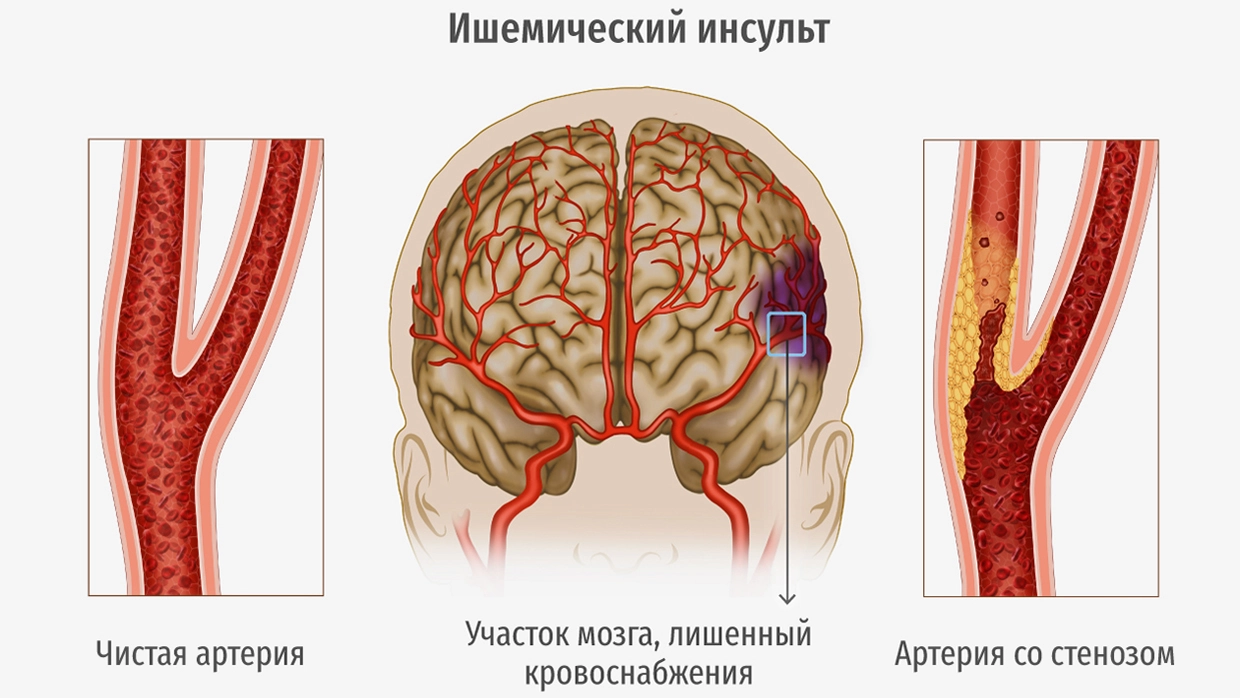 Лечение стеноза сонных артерий по ОМС